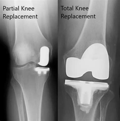 Difference Between A Partial And Total Knee Replacement