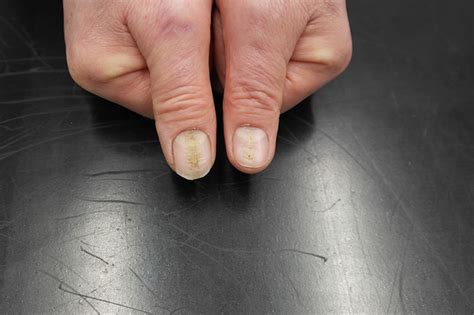 A consequence of habitual nail bed trauma | The BMJ