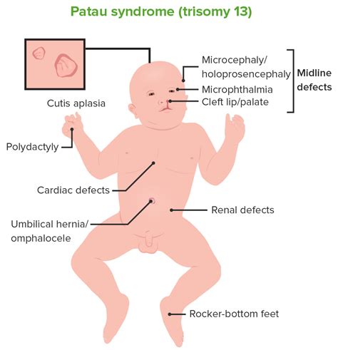 Cleft Lip and Cleft Palate | Concise Medical Knowledge