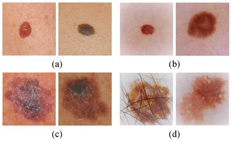 Melanoma Skin Cancer Stages