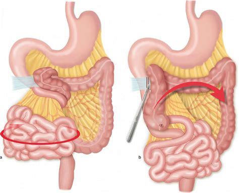 Cecal Vs Sigmoid Volvulus - Mari-Kiketi