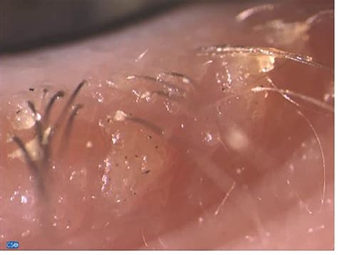 Demodex infestation: Diagnosis and management - Insight