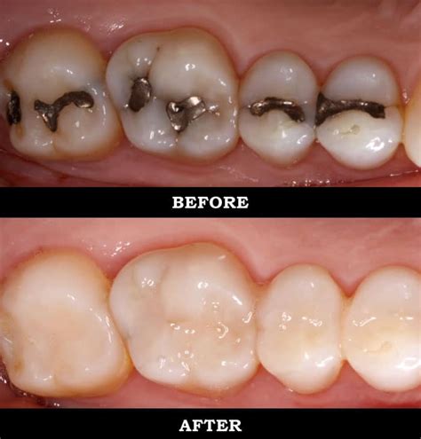 Amalgam (Silver) vs. Composite Resin (White) Fillings | Allen Dental