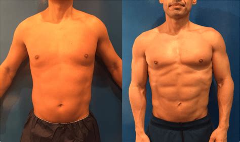 Before & After: Male Liposuction Results | Neinstein Plastic Surgery