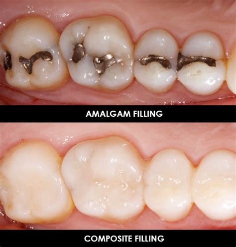 how do composite fillings work - Bunyanesque E-Journal Photography