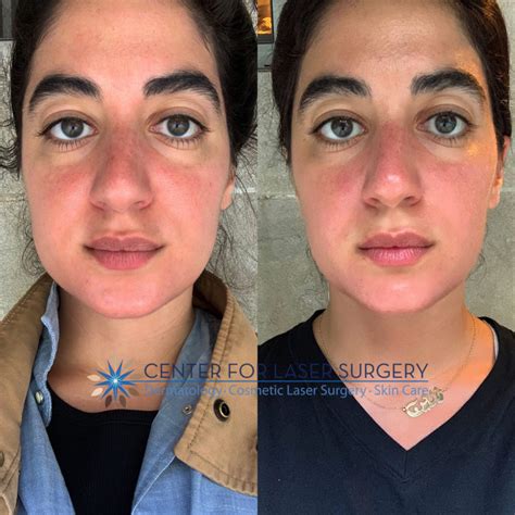 Botox for TMJ and Facial Contouring | Washington, DC | Center for Laser Surgery