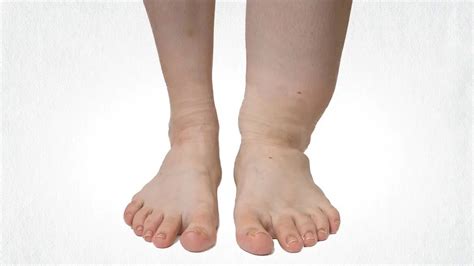 Filariasis; Causes, Symptoms, Diagnosis, Treatment - Rxharun