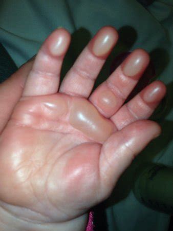 2nd degree burns all over her hand *pic. Update pg 13 | BabyCenter