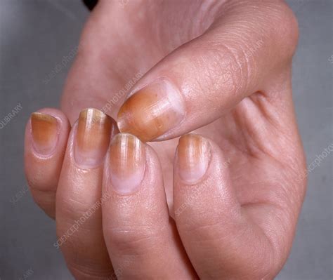 Discoloured fingernails - Stock Image - C049/4519 - Science Photo Library