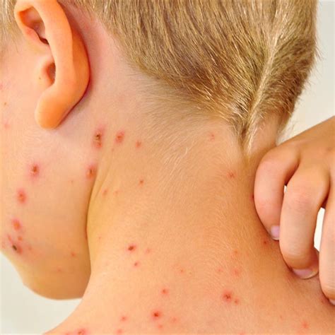 Chickenpox (Varicella) Vaccine: What You Need to Know - HealthyChildren.org