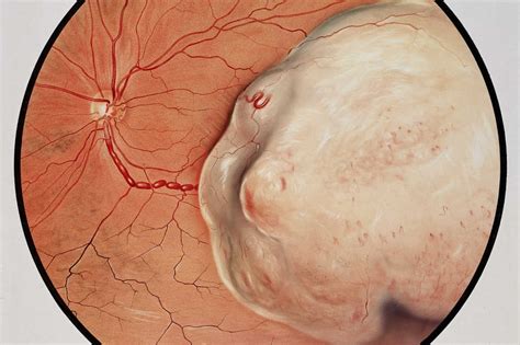 Choroidal melanoma treatment advances