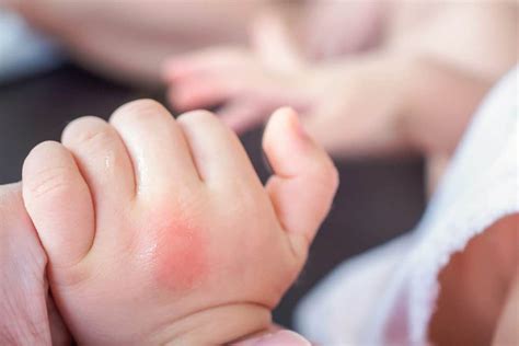 Insect Bites on Babies: See How to Treat Them