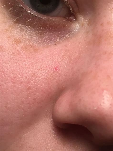 [Skin Concerns] What is this permanent red dot on my face? | Nose ring, Skin concern, Skin