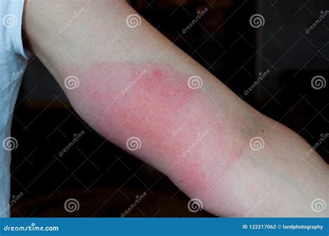 Red arm hurt. Skin allergy stock photo. Image of swollen - 122217062