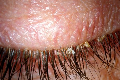 What Is Blepharitis Symptoms And Diagnosis Of Blepharitis How | Hot Sex ...