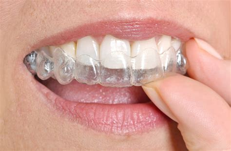 Invisalign : gouttière d’alignement transparente