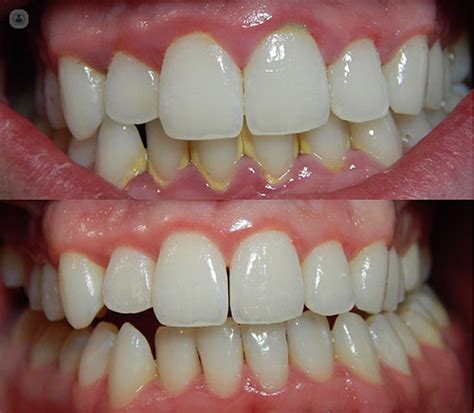 Gingivitis: what is it, symptoms and treatment | Top Doctors