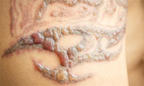 Is Tattoo Removal Safe?