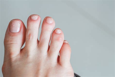 Causes Of White Spots On Your Toenails – My FootDr