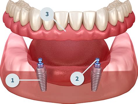 Implant Supported Dentures | Touchstone Dentistry