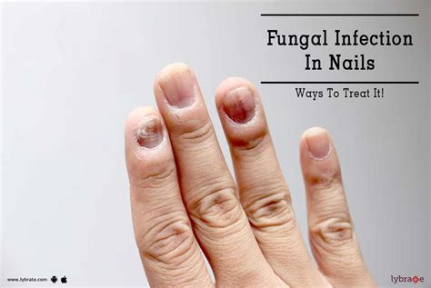 Home Remedies For Nail Fungus Infection | atelier-yuwa.ciao.jp