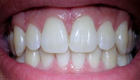 Do You Have Healthy Gums? | Fiveways Dental Liverpool
