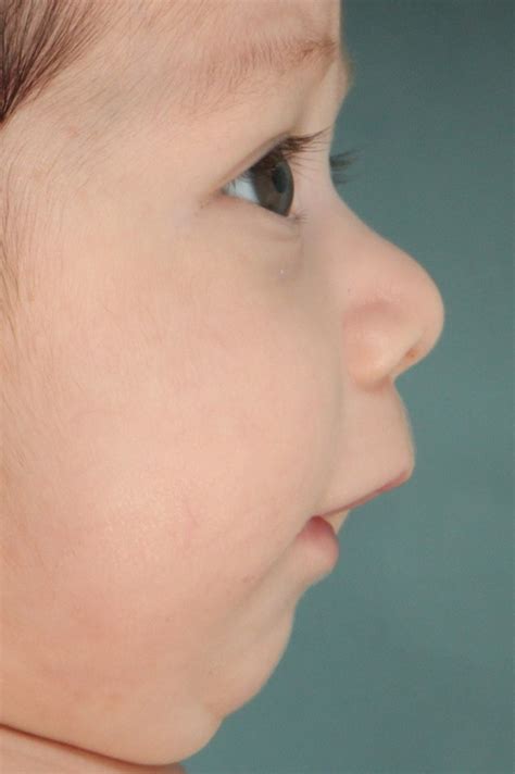 Two year old mouth open retrognathic mandible - Orofacial Myology