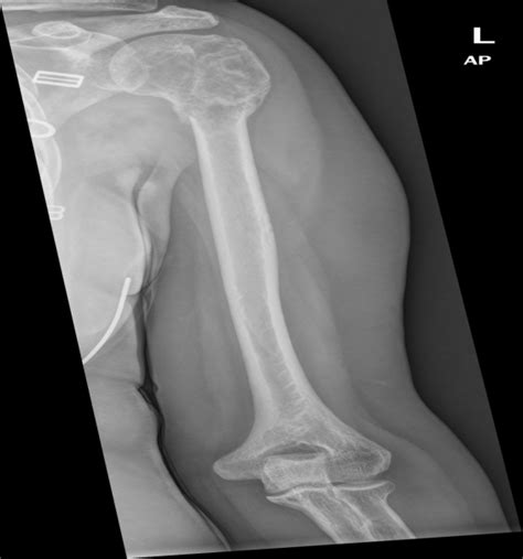 Case of the Month: Humeral Mass - University of Rochester Medical Center