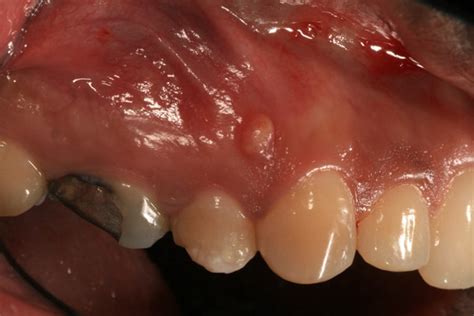 Dental Fistula Diagram