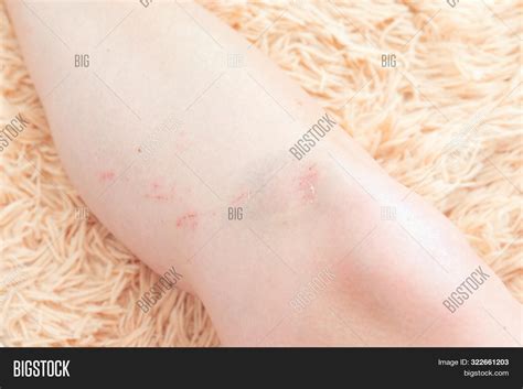 Bruised Knee. Image & Photo (Free Trial) | Bigstock