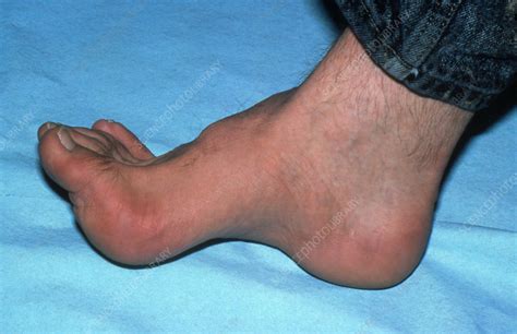 Claw foot (pes cavus) - Stock Image - M350/0180 - Science Photo Library