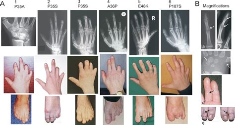 A New Subtype of Brachydactyly Type B Caused by Point Mutations in the ...