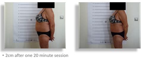 Results - Lipo-Light