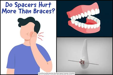 Do spacers hurt more than braces | Orthodontic Braces Care