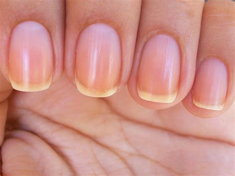 What Vitamin Deficiency Causes Vertical Lines In Nails - Design Talk