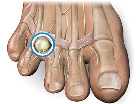 Lump On Toe: Causes & Treatment For Toe Lumps & Bumps