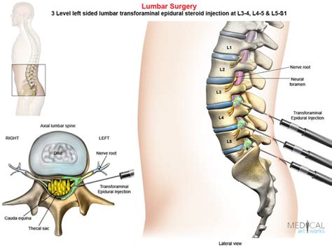 3 Level - Left-side lumbar Transforaminal Epidural Injection - Male — Medical Art Works