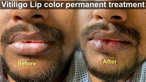 Permanent Lip color correction Treatment for dark lips and white patch ...
