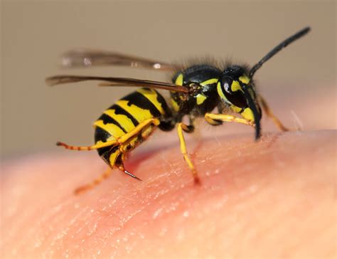 How to Treat a Hornet Sting at Home