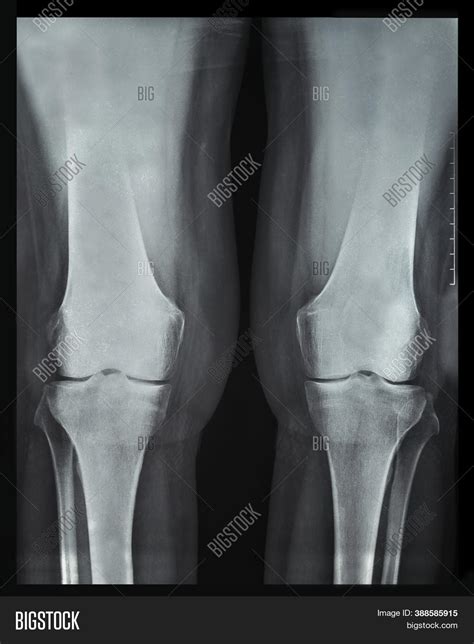 X-ray Rheumatic Image & Photo (Free Trial) | Bigstock