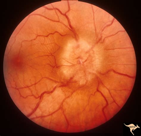 Papilledema Stages