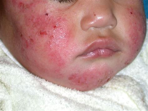 Atopic Dermatitis Face Treatment - Doctor Heck