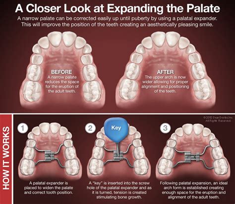 Habit Breaking Appliances & Orthodontic Expansion Plates - Smayate Dental Clinic