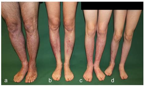 EBJ | Free Full-Text | Skin Healing of Deep Second Degree Burn Injuries in Four Individuals ...