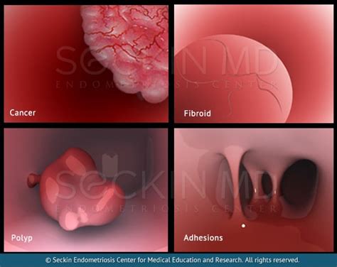 Internal Abdominal Scar Tissue Symptoms