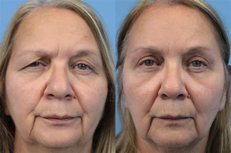 Blepharoplasty (Upper Eyelid Lift) Before and After Pictures Case 197 ...