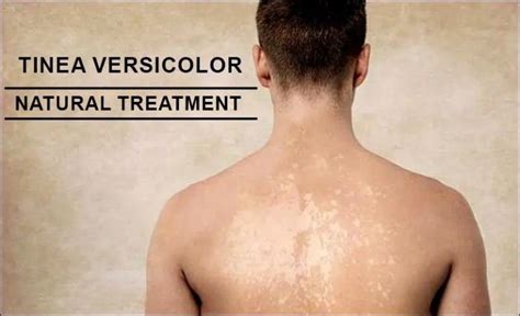 Natural Treatment for Tinea Versicolor - Safest Way to Heal It