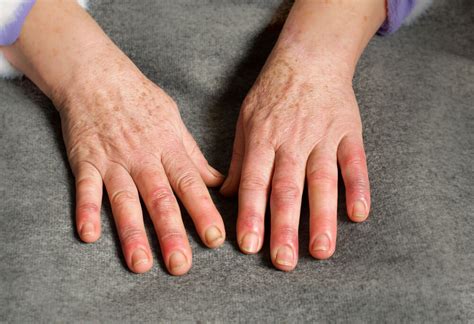 Swollen Fingers: Causes, Treatment, Risks | lupon.gov.ph