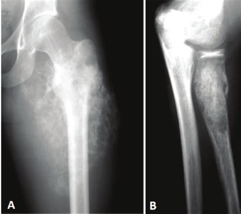 Radiographies of osteosarcoma (A) and Ewing’s sarcoma (B). Ill defined... | Download Scientific ...