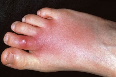 [Get 35+] Scabies Eczema Rash On Hands